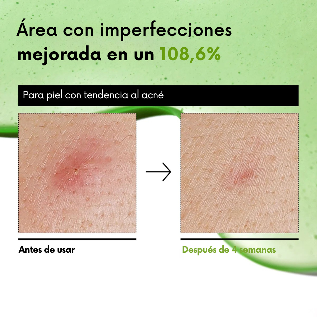 Sérum Calmante para Piel Sensible con Tendencia Acneica